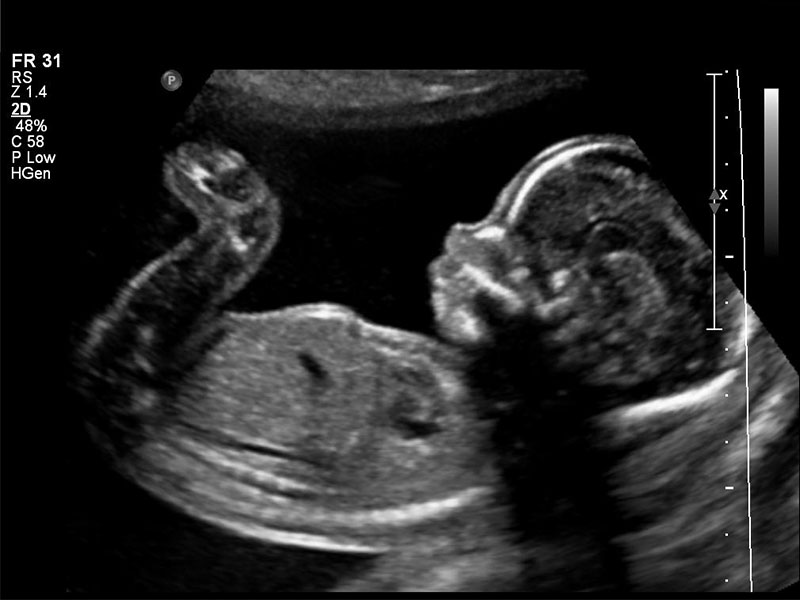 اولتراسوند / ultrasound