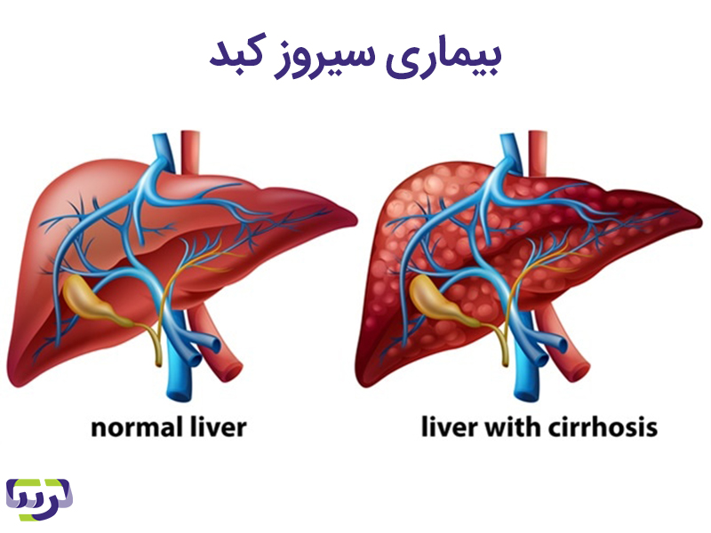 بیماری سیروز کبد / liver cirrhosis