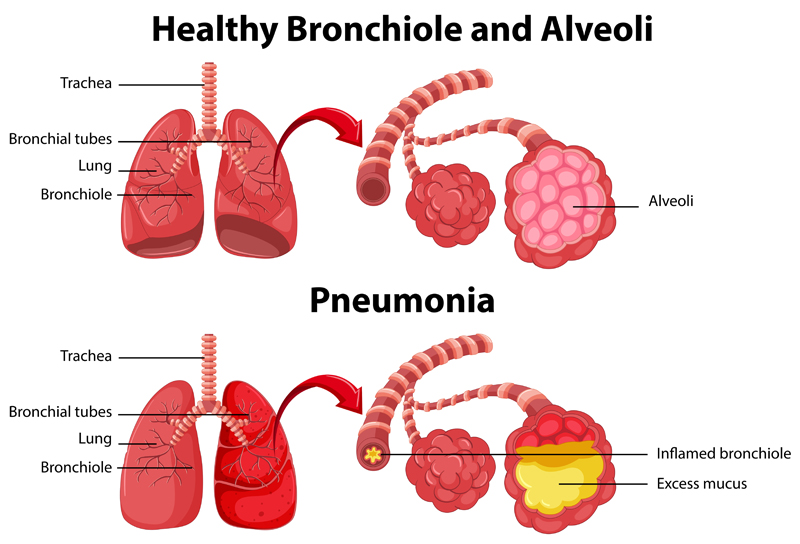 مقایسه ریه سالم و عفونی - Healthy Bronchiole and Alveoli and Pneumonia - تریتا