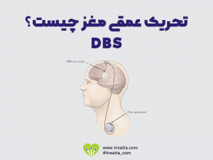 تحریک عمقی مغز / DBS