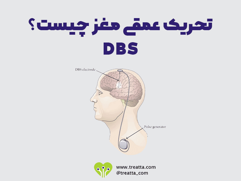 تحریک عمقی مغز / DBS