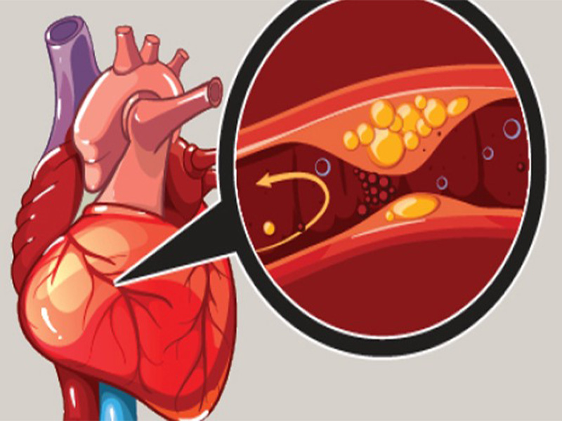 آنژیوگرافی قلب چیست؟/what is coronary angiography