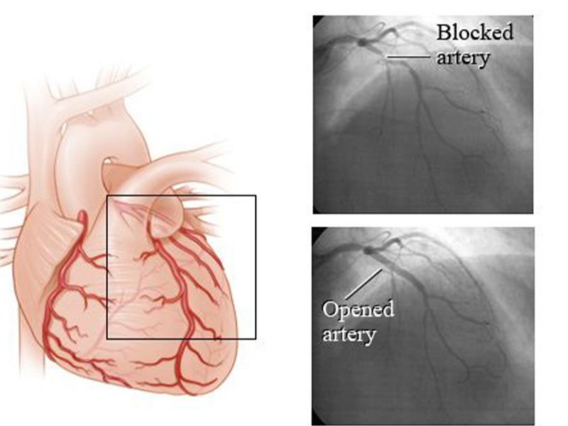 آنژیوگرافی قلب چیست؟ what is coronary angiography