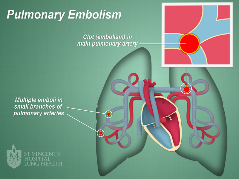 آمبولی ریه/Pulmonary Embolism