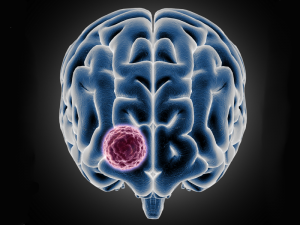 تومور مغزی/brain tumor