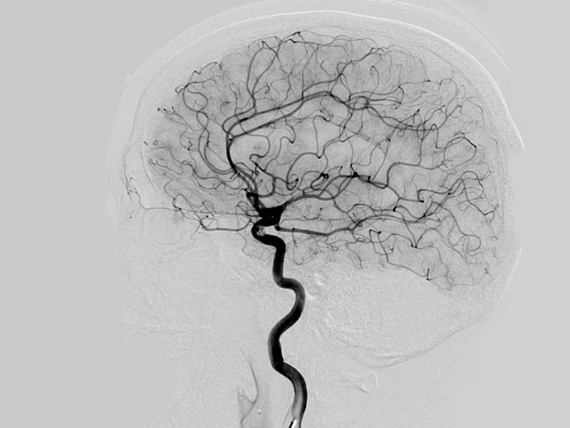 آنژیوگرافی مغز/brain angiography