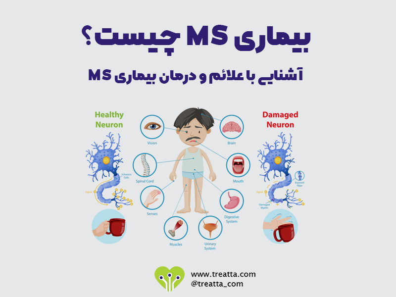بیماری ام اس/MS Disease