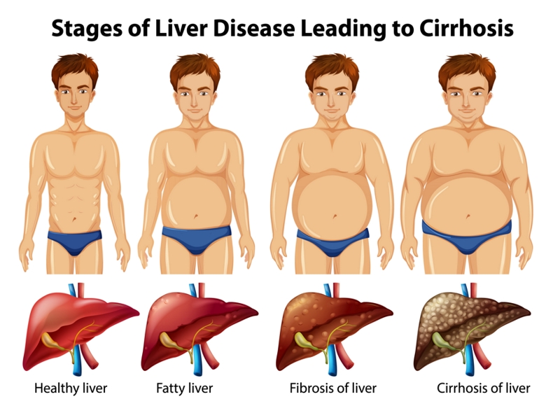 مراحل بیماری کبد چرب/fatty liver stages
