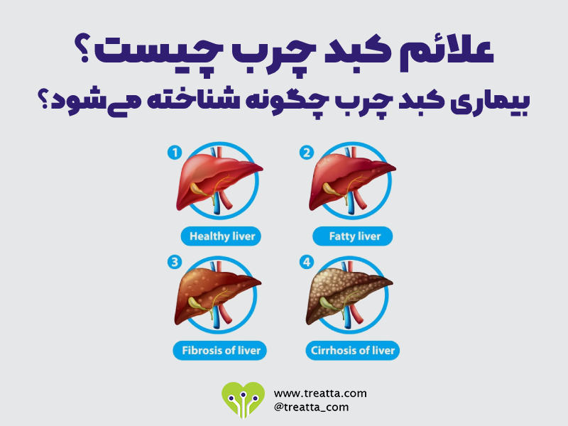 علائم کبد چرب/fatty liver symptoms