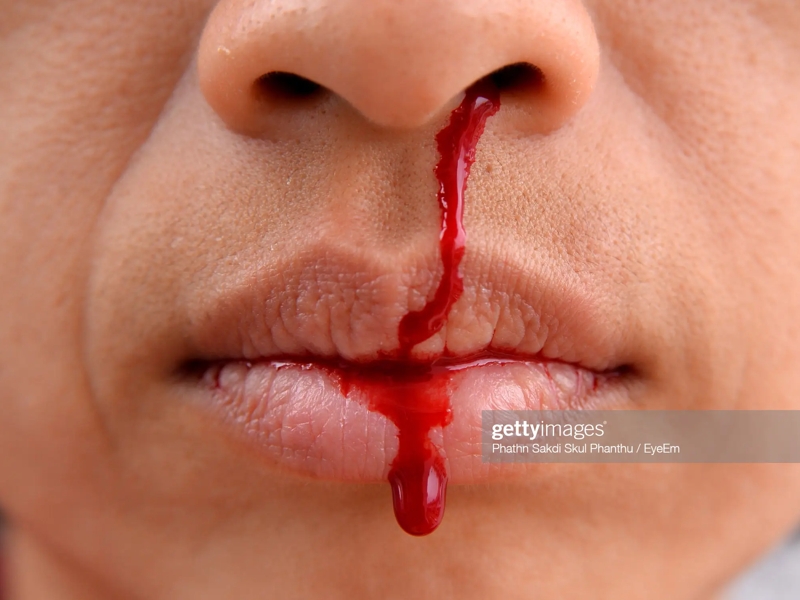 خون دماغ شدن |‌ nosebleeding
