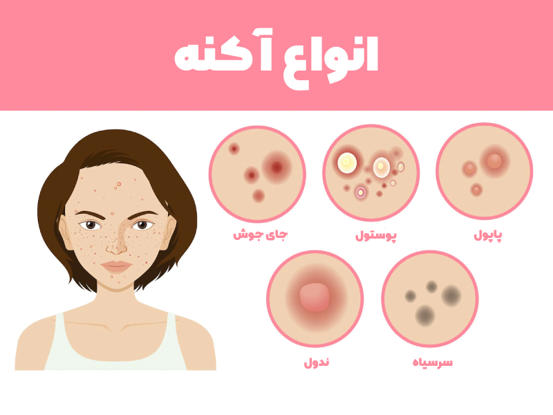 انواع آکنه | types of acne